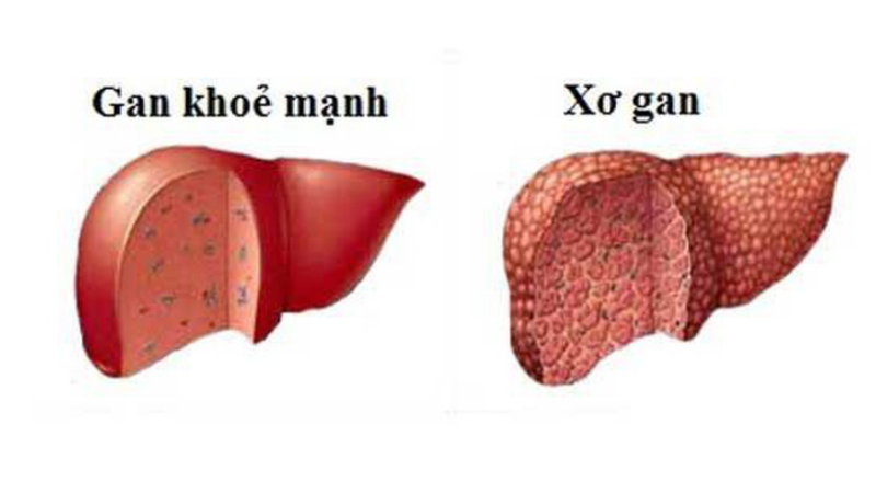 Căn bệnh xơ gan Hưng “kính” mắc phải nguy hiểm như thế nào?