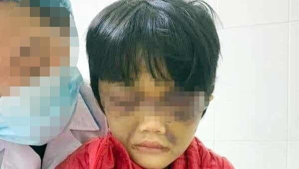 Bé gái 6 tuổi đang được điều trị tại Bệnh viện Đa khoa tỉnh Hải Dương.