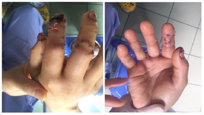 Ngón tay của bệnh nhân  kịp thời được bác sĩ phãu thuật thành công.