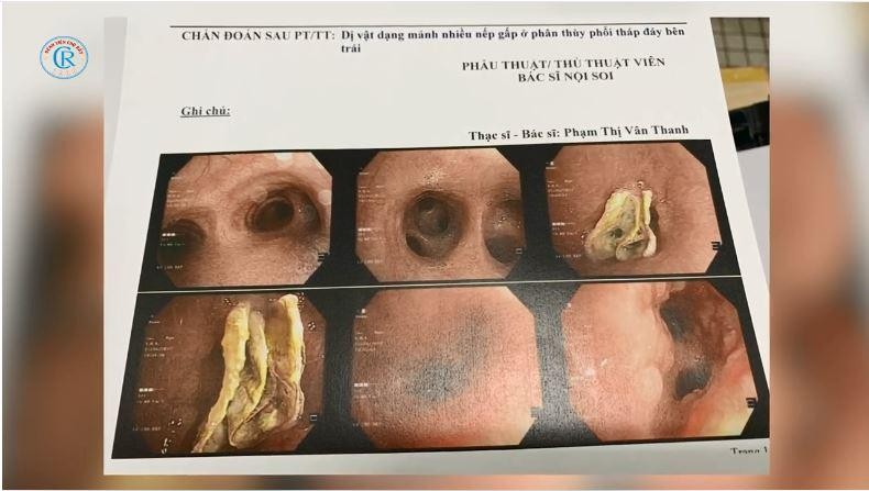 Hình ảnh nội soi phế quản của bệnh nhân. Ảnh: BVCC