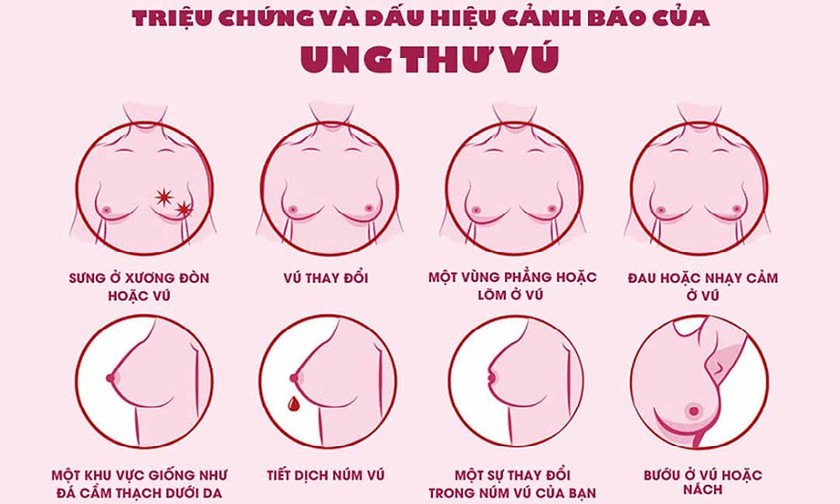 Triệu chứng và dấu hiệu cảnh báo ung thư vú. Ảnh: BVCC