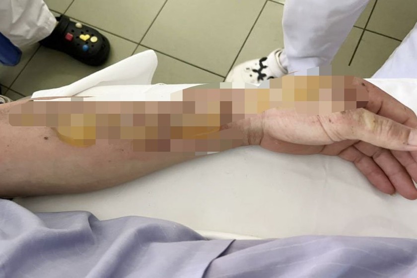 Vết bỏng vùng cánh tay của người bệnh P. Ảnh: Bệnh viện cung cấp
