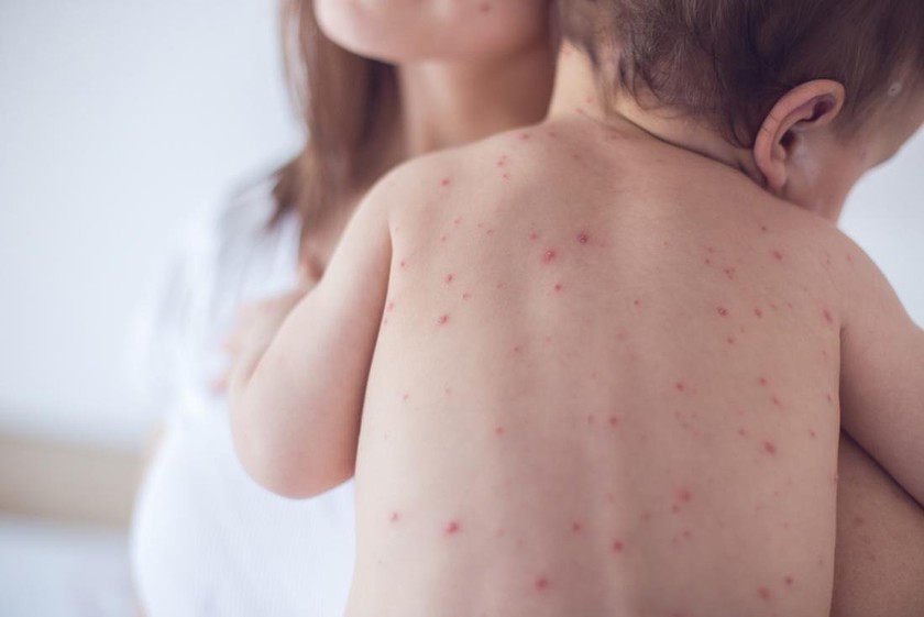 Khẩn trương triển khai Chiến dịch tiêm hơn 1 triệu liều vaccine sởi