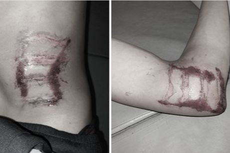 Hình ảnh vết thương bệnh nhân do bị sét đánh lúc mới nhập viện