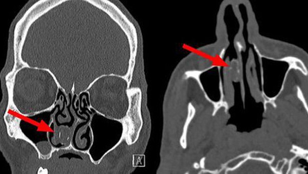 Cần sa bị mắc kẹt 18 năm trong lỗ mũi của cựu tù nhân 