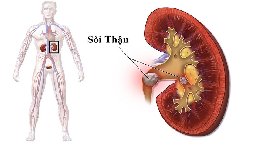 Nhịn tiểu sẽ dẫn đến nguy cơ hình thành cặn sỏi, rối loạn tiểu tiện. Ảnh: minh họa