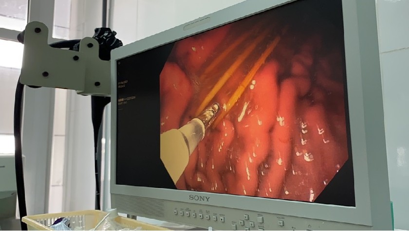 Hình ảnh tăm tre trong dạ dày của bệnh nhân (Ảnh: BVCC)