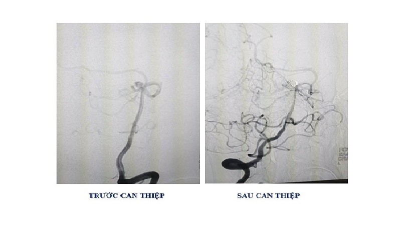 Hình ảnh chụp trước và sau can thiệp. Ảnh: BVCC