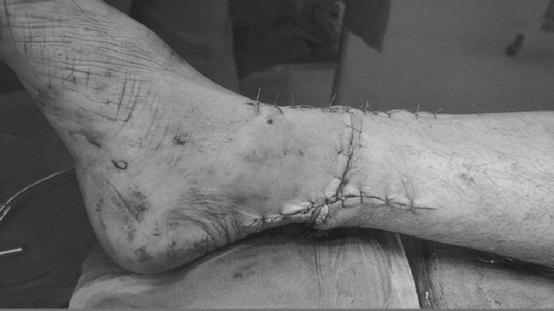Phần cổ chân của bệnh nhân được nối liền sau phẫu thuật. Ảnh: BVCC