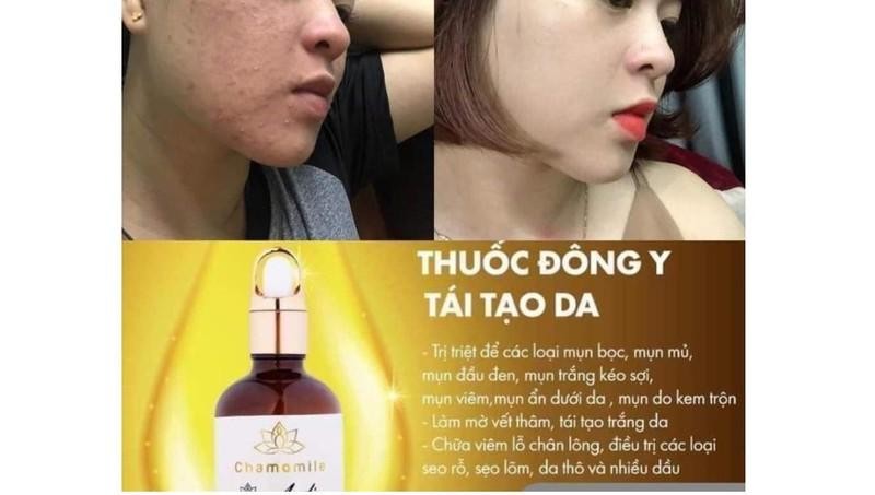 Tinh chất mụn ACNE SKIN SERUM "nổ" như thuốc đông y điều trị