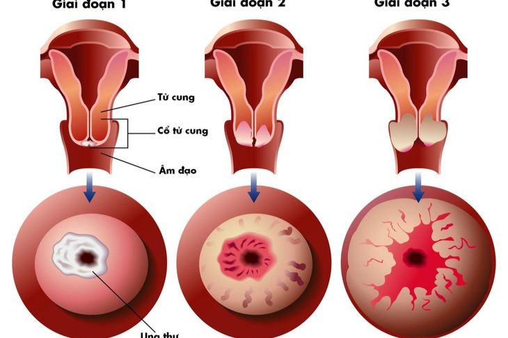 Các mức tổn thương theo từng giai đoạn của ung thư cổ tử cung.