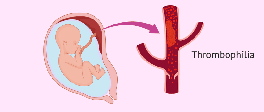 Mắc hội chứng tăng đông Thrombophilia là một trong những nguyên nhân gây ra sảy thai liên tiếp thường gặp