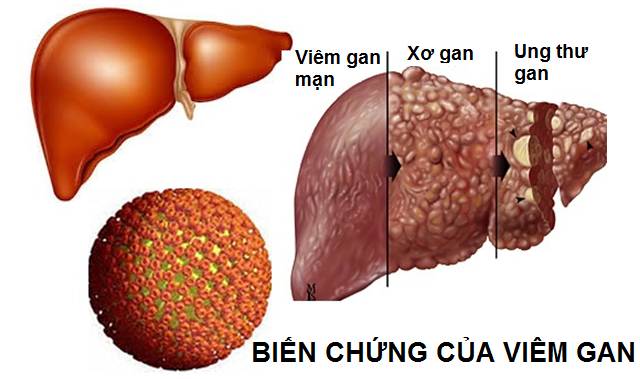 Xét nghiệm mới phát hiện sớm ung thư gan dưới 2cm