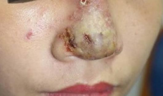Mũi biến thành ổ mủ sau khi tiêm chất làm đầy Filler