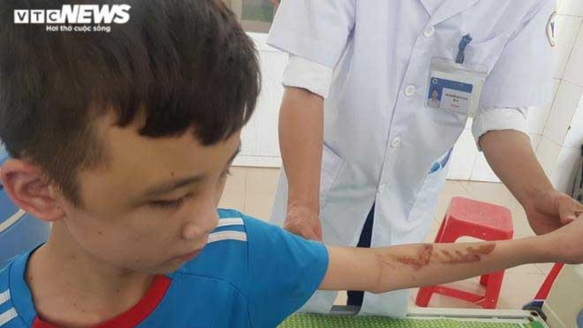 Bắc Ninh ra văn bản hỏa tốc sau vụ nhân viên quán bánh xèo bị tra tấn ảnh 1 Cậu bé 14 tuổi bị chủ quán bánh xèo bạo hành với chi chít vết thương trên người, mặt bầm tím. (Ảnh VTC News)