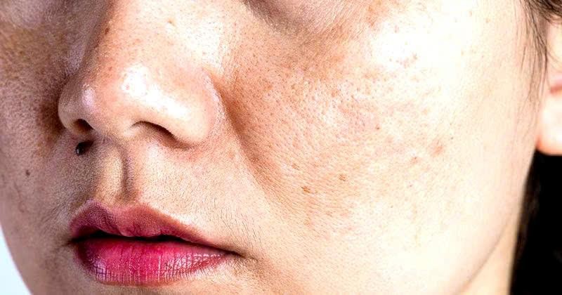 Skincare đều, da vẫn chưa đẹp: Bạn có đang dưỡng ẩm đúng cách?