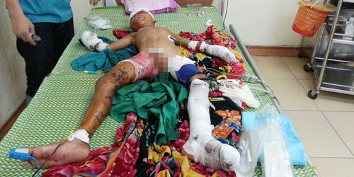 Nam sinh nhập viện nguy kịch khi đấu dây điện vào vật lạ nhặt trên bãi biển 