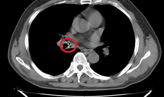 Dị vật được phát hiện trong lòng phế quản của bệnh nhân. 