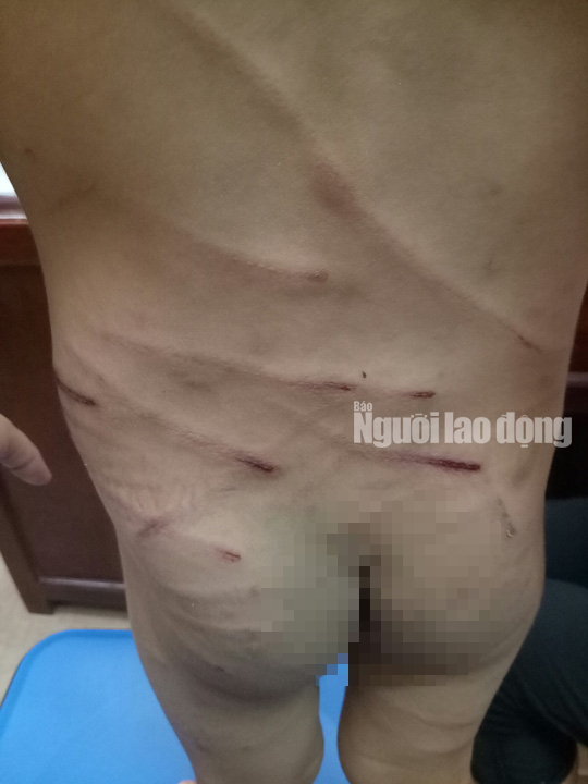 Giải cứu bé trai 3 tuổi bị cha dượng đánh dã man ở Phú Quốc - Ảnh 2. Giải cứu bé trai 3 tuổi bị cha dượng đánh dã man ở Phú Quốc - Ảnh 2.