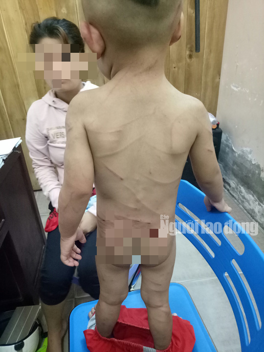 Giải cứu bé trai 3 tuổi bị cha dượng đánh dã man ở Phú Quốc - Ảnh 1. Giải cứu bé trai 3 tuổi bị cha dượng đánh dã man ở Phú Quốc - Ảnh 1.