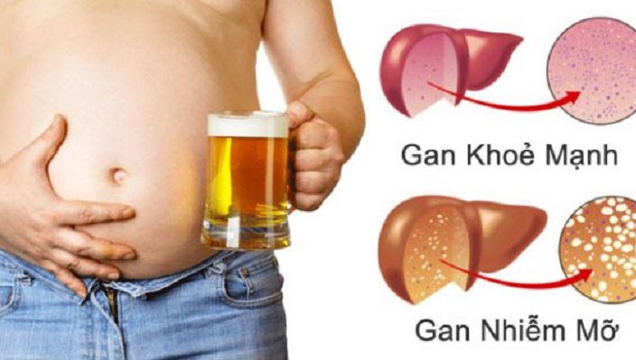 Hiểu nhầm tai hại khiến gan nhiễm mỡ 