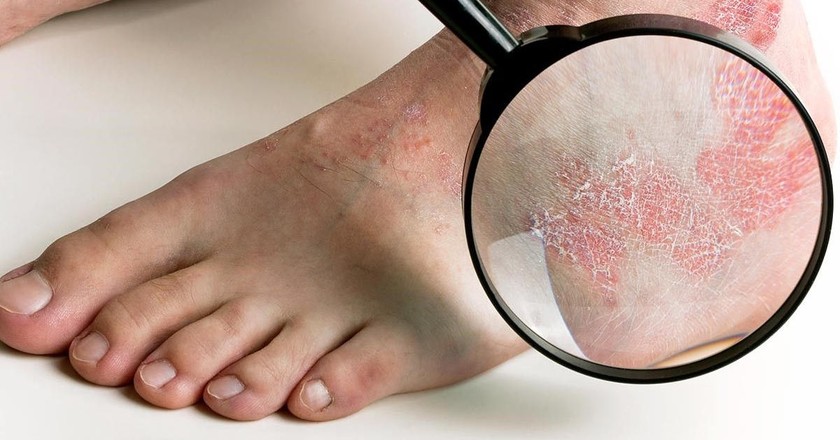 6 bệnh thường gặp sau mưa lũ và biện pháp điều trị ảnh 2 6 bệnh thường gặp sau mưa lũ và biện pháp điều trị ảnh 2