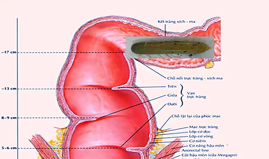 Quả dưa leo có bọc bao cao su bên ngoài lọt vào tận kết tràng xích ma của bệnh nhân.