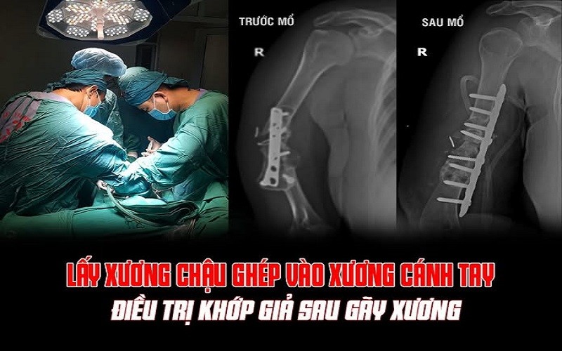 Sau khoảng 90 phút ca phẫu thuật đã hoàn thành.