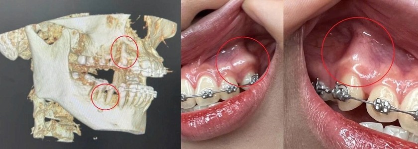 Hình ảnh biến chứng của niềng răng hỏng. (Ảnh minh họa)
