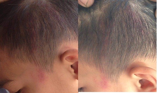 Vết đỏ hằn trên đầu học sinh Đức
