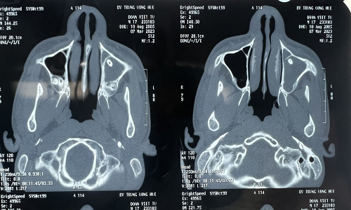 Bệnh nhân được chẩn đoán dị vật xoang hàm trái ngày thứ 8.