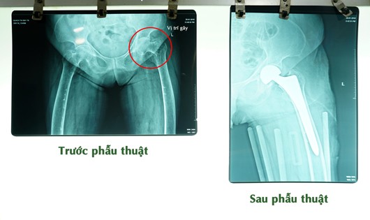 Kết quả chụp phim của bà Q.T.B do té ngã