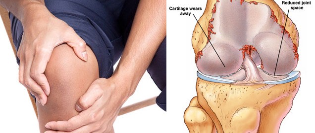 Bật mí cách điều trị đau khớp gối nhanh và hiệu quả