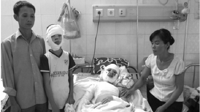 Một trường hợp cả anh em đều bị bỏng cồn vì xem chú nướng mực.