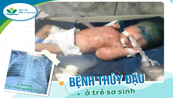 Trẻ sơ sinh bị biến chứng do mắc thủy đậu. Ảnh: BVCC
