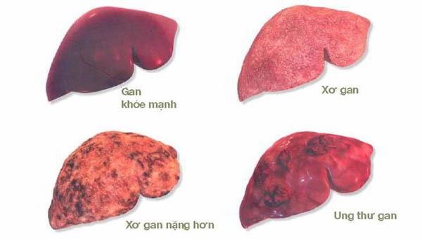 Chuyên gia cảnh báo những dấu hiệu mắc ung thư gan