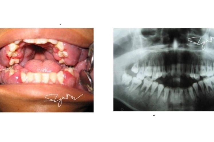 Bệnh nhân đi khám phát hiện bệnh u máu ác tính. Ảnh: BVCC