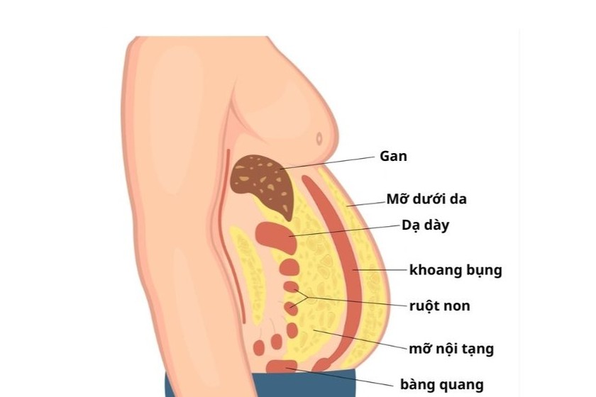 Hiểm họa khôn lường từ mỡ nội tạng 