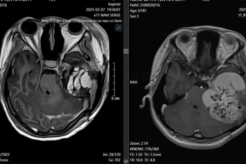 Khối u nền sọ bên trái phát triển từ xương đá. Phim MRI trước phẫu thuật (bên phải) và sau phẫu thuật (bên trái). Ảnh: Bệnh viện cung cấp