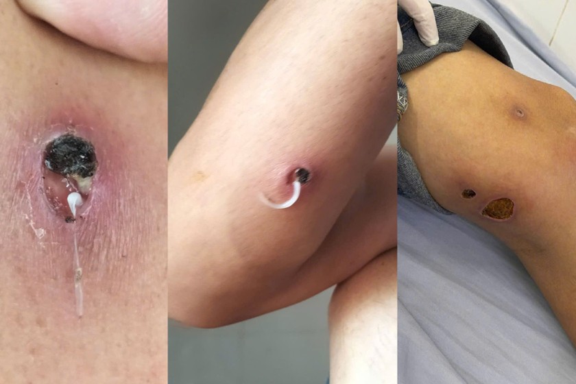 Giun rồng Dracunculus – một căn bệnh ký sinh trùng hiếm gặp, nguy hiểm, từng được loại trừ tại Việt Nam. Ảnh: Trung tâm Y tế huyện Tân Sơn, tỉnh Phú Thọ