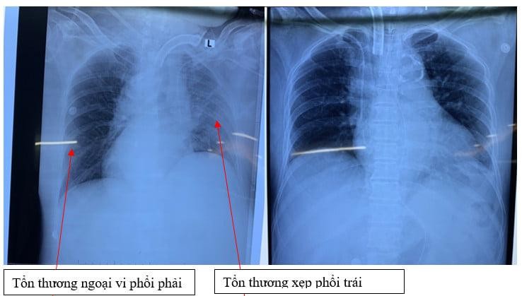 XQ phổi thời điểm vào viện và ra viện Ảnh: BVCC