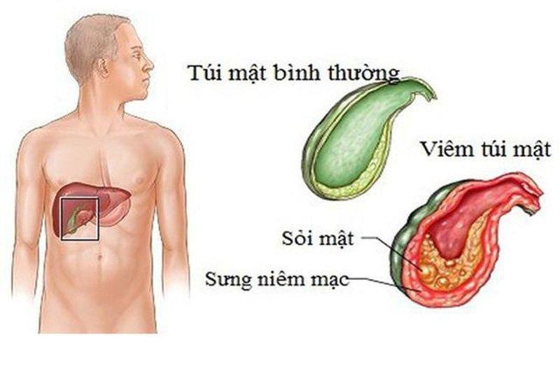 Túi mật bình thường và túi mật bị Ảnh: Vinmec