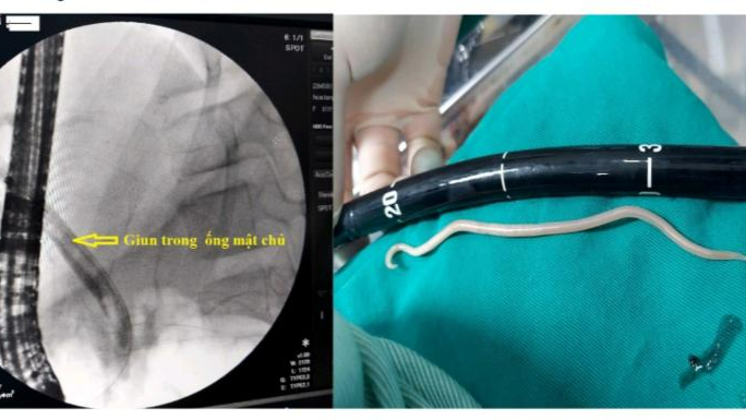 Hình ảnh giun trong ống mật trên màn hình tăng sáng C-Arm và giun sau khi lấy ra ngoài. Ảnh: BVCC