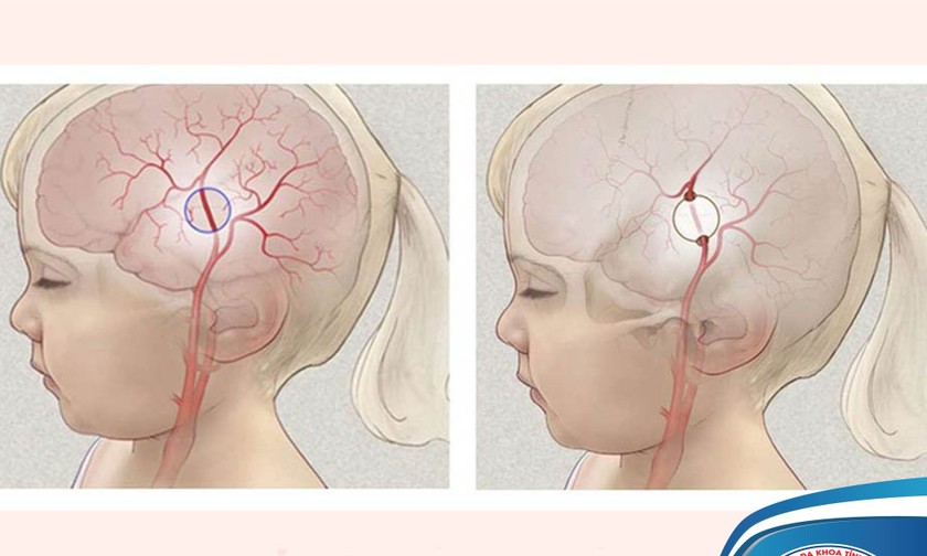 Bệnh Moya Moya. Ảnh: BVCC