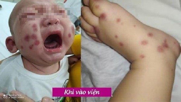 Trên má, vành tai và chân, tay của bé trai xuất hiện nhiều mảng xuất huyết khi mới vào viện. Ảnh: BVCC