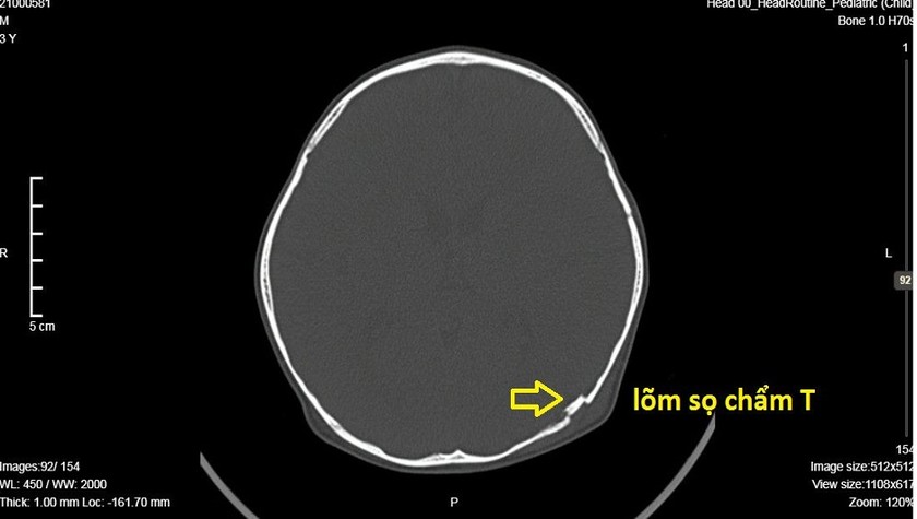 Sau cú ngã, bé trai 2 tuổi bị lõm hộp sọ. Ảnh: BVCC