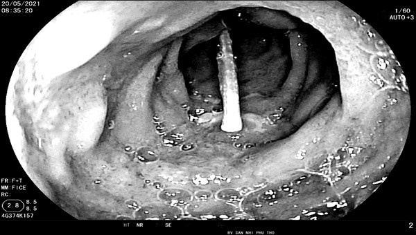 Hình ảnh dị vật tăm trong tá tràng bệnh nhi Ảnh: Bệnh viện cung cấp.