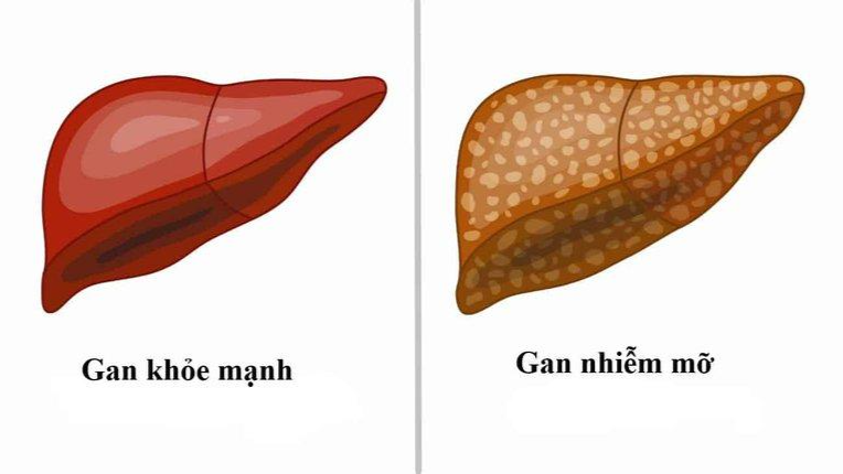 Ảnh minh họa gan nhiễm mỡ. 