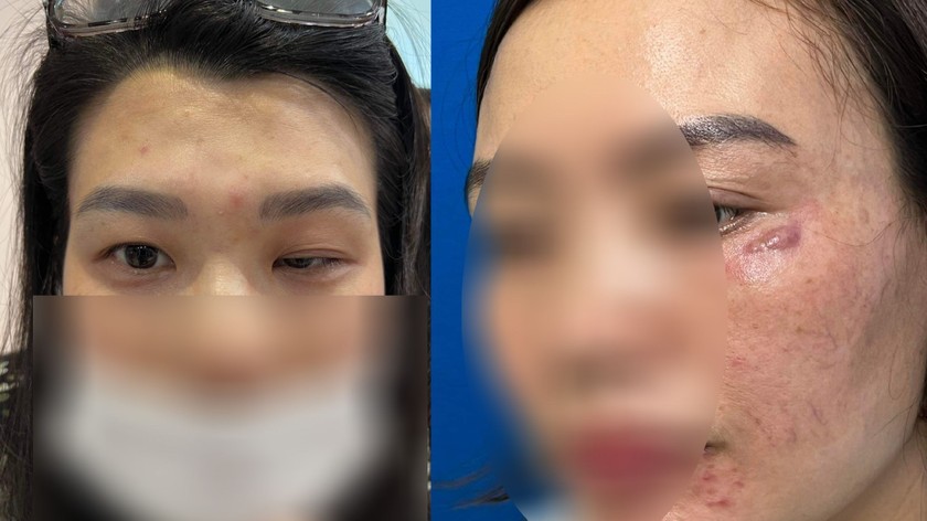 Bệnh nhân bị biến chứng sau tiêm Botolium Toxin (Botox). Ảnh do Bệnh viện cung cấp