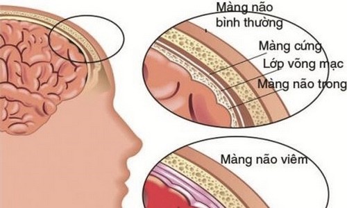 Hình ảnh viêm màng não. Nguồn internet